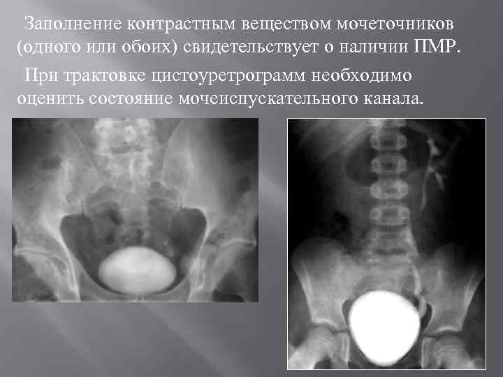 Заполнение контрастным веществом мочеточников (одного или обоих) свидетельствует о наличии ПМР. При трактовке цистоуретрограмм