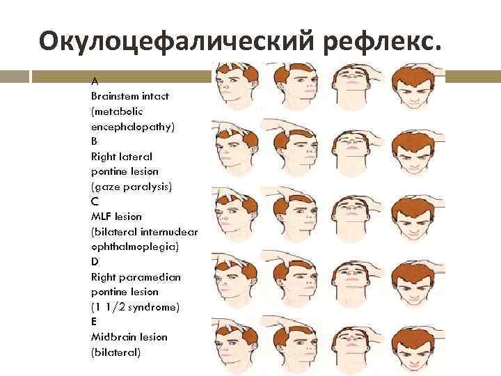 Окулоцефалический рефлекс. A Brainstem intact (metabolic encephalopathy) B Right lateral pontine lesion (gaze paralysis)