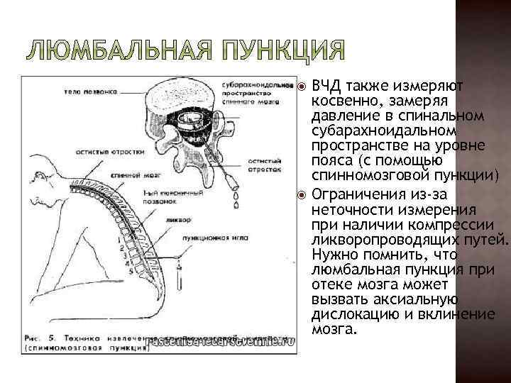  ВЧД также измеряют косвенно, замеряя давление в спинальном субарахноидальном пространстве на уровне пояса