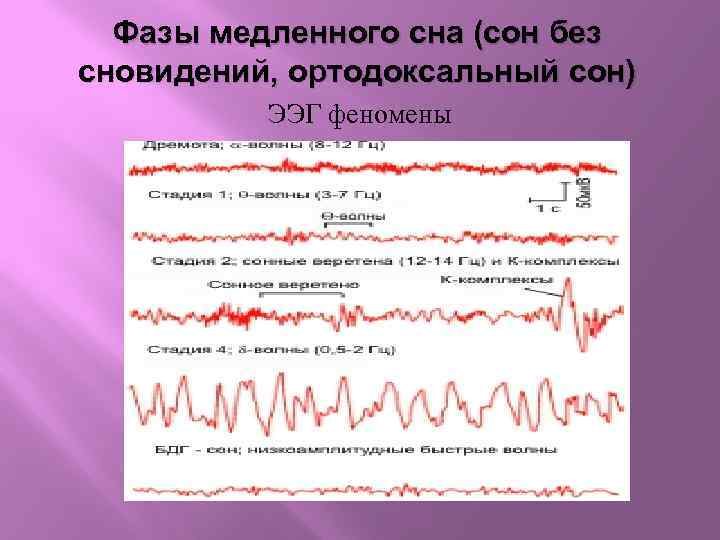 Фазы медленного сна (сон без сновидений, ортодоксальный сон) ЭЭГ феномены 