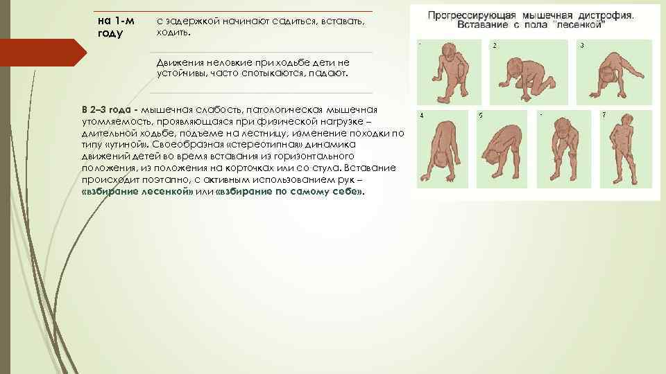 на 1 м году с задержкой начинают садиться, вставать, ходить. Движения неловкие при ходьбе