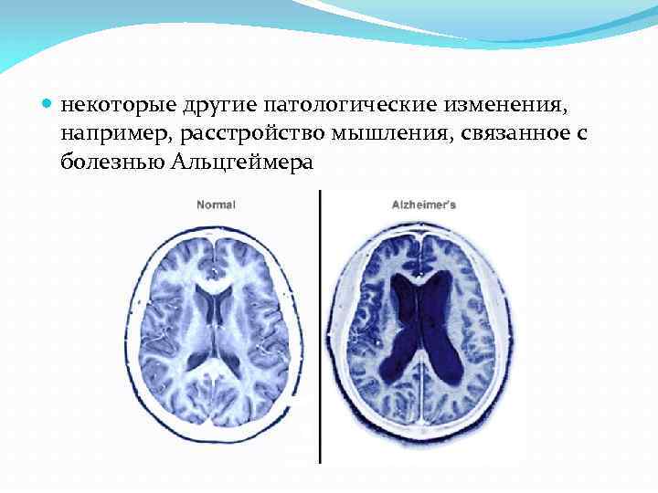 Субатрофические изменения мозга
