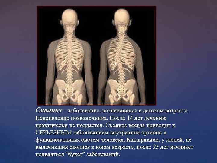 Сколиоз – заболевание, возникающее в детском возрасте. Искривление позвоночника. После 14 лет лечению практически