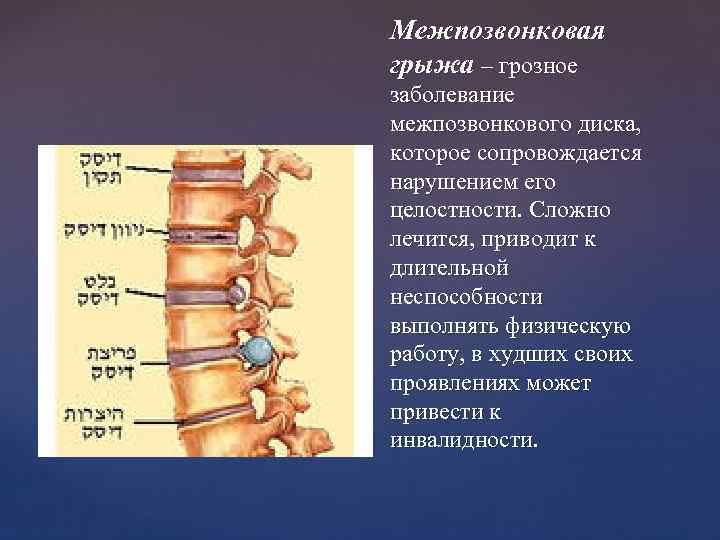 Межпозвонковая грыжа – грозное заболевание межпозвонкового диска, которое сопровождается нарушением его целостности. Сложно лечится,