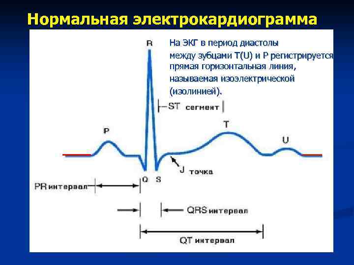 Нормальная электрокардиограмма На ЭКГ в период диастолы между зубцами Т(U) и Р регистрируется прямая