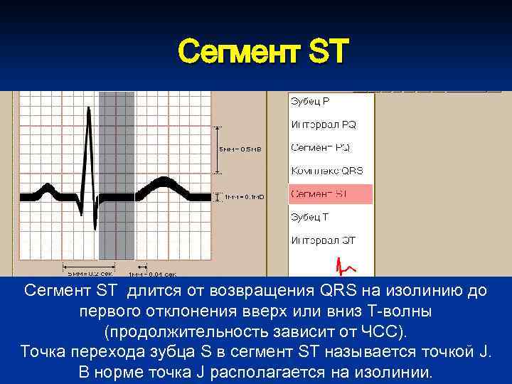 Сегмент ST длится от возвращения QRS на изолинию до первого отклонения вверх или вниз