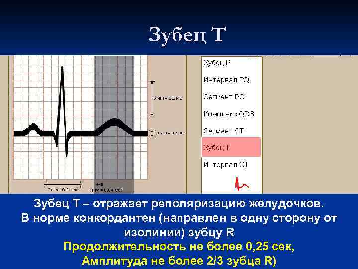 Зубец Т – отражает реполяризацию желудочков. В норме конкордантен (направлен в одну сторону от