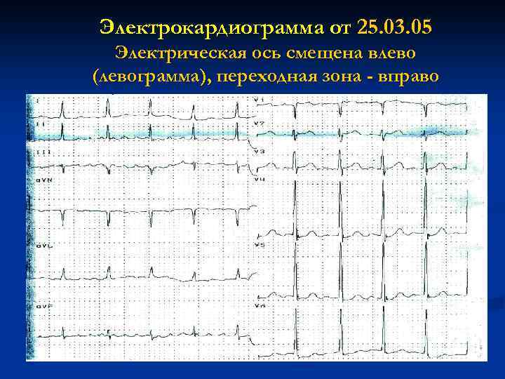 Электрокардиограмма от 25. 03. 05 Электрическая ось смещена влево (левограмма), переходная зона - вправо