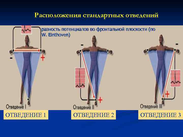 Расположения стандартных отведений разность потенциалов во фронтальной плоскости (по W. Einthoven) ОТВЕДЕНИЕ 1 ОТВЕДЕНИЕ