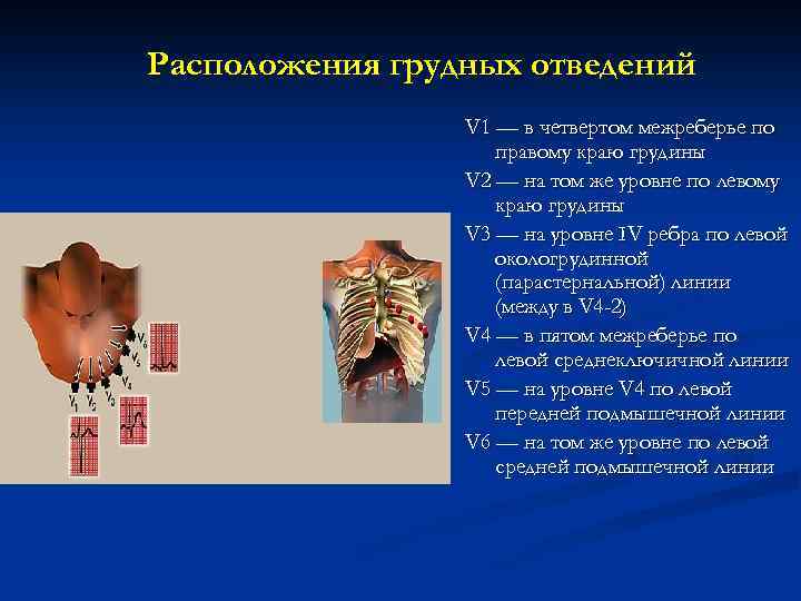 Расположения грудных отведений V 1 — в четвертом межреберье по правому краю грудины V