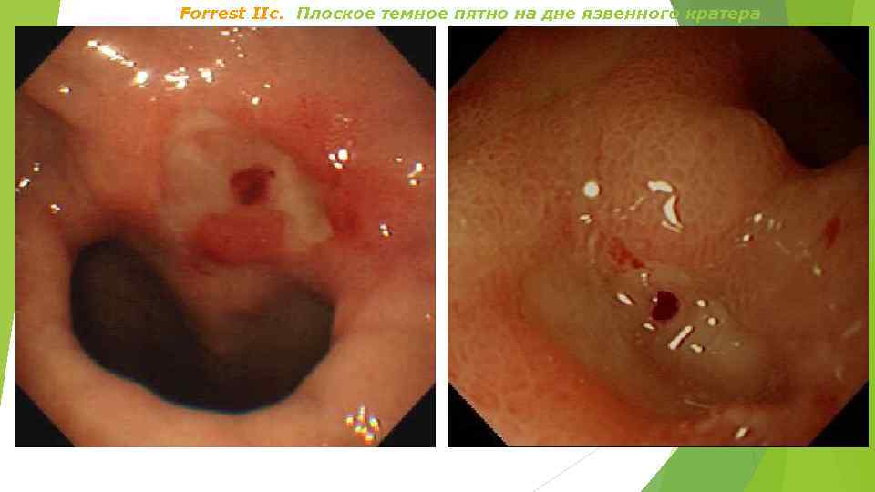 Forrest IIс. Плоское темное пятно на дне язвенного кратера 