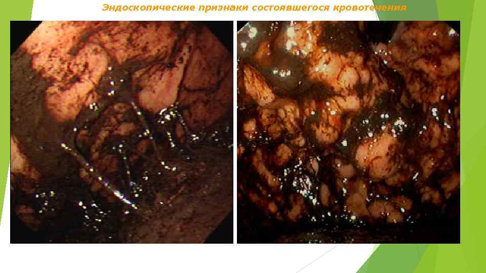 Эндоскопические признаки состоявшегося кровотечения 