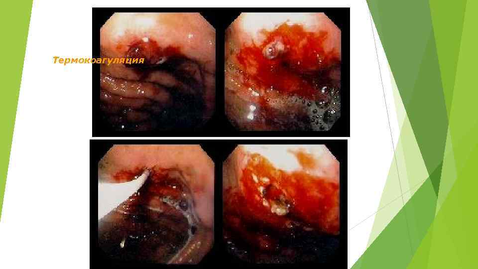 Термокоагуляция 
