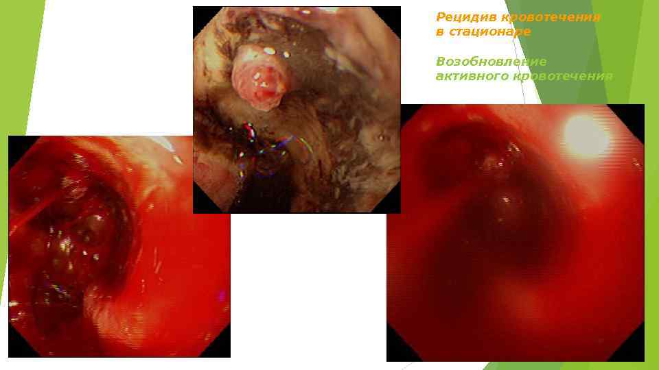 Рецидив кровотечения в стационаре Возобновление активного кровотечения 