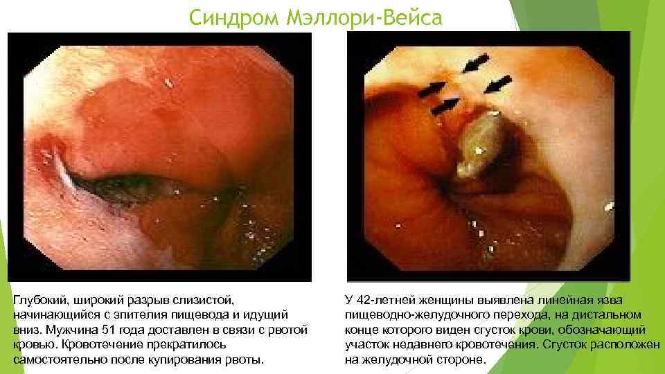 Синдром Мэллори-Вейса Глубокий, широкий разрыв слизистой, начинающийся с эпителия пищевода и идущий вниз. Мужчина