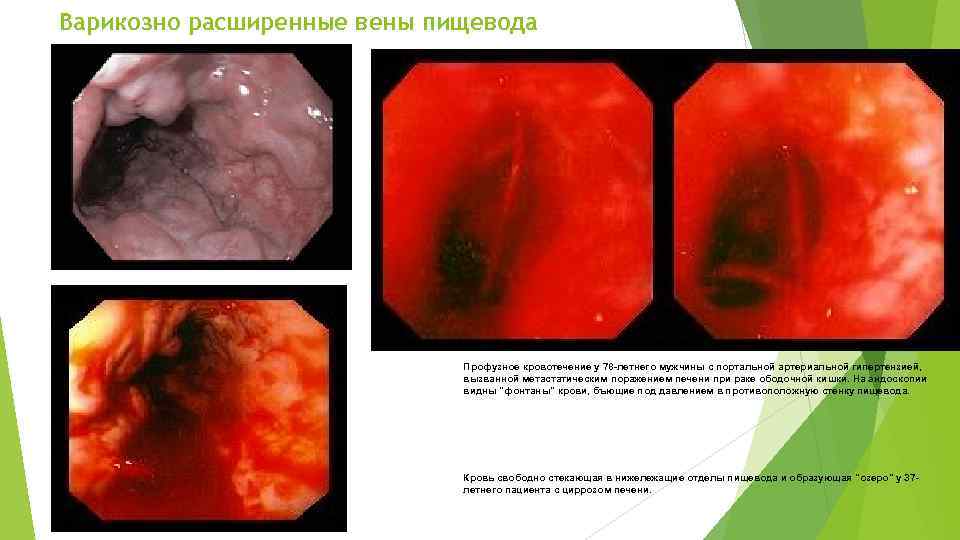 Варикозно расширенные вены пищевода Профузное кровотечение у 78 -летнего мужчины с портальной артериальной гипертензией,