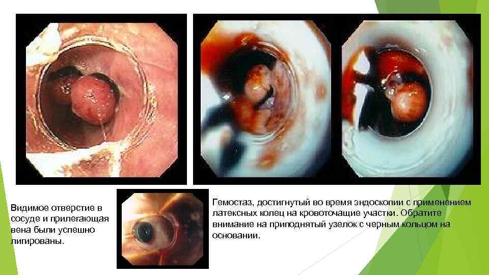 Видимое отверстие в сосуде и прилегающая вена были успешно лигированы. Гемостаз, достигнутый во время