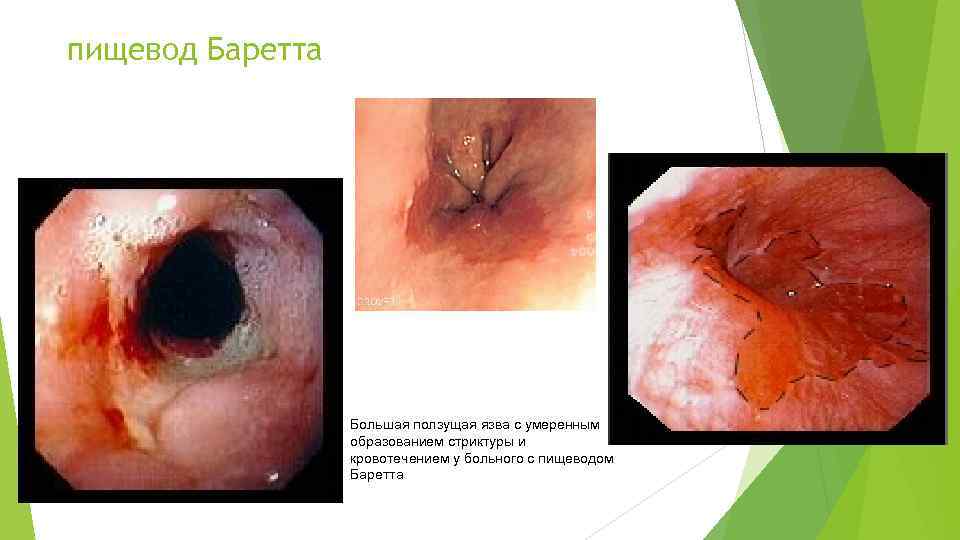 пищевод Баретта Большая ползущая язва с умеренным образованием стриктуры и кровотечением у больного с