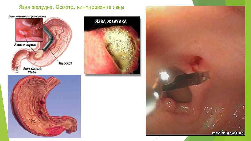 Язва желудка. Осмотр, клипирование язвы 