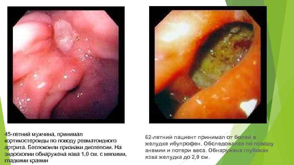 45 -летний мужчина, принимал кортикостероиды по поводу ревматоидного артрита. Беспокоили признаки диспепсии. На эндоскопии