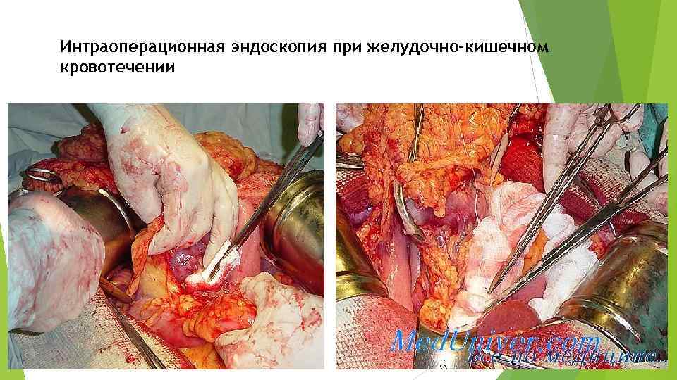 Интраоперационная эндоскопия при желудочно-кишечном кровотечении 
