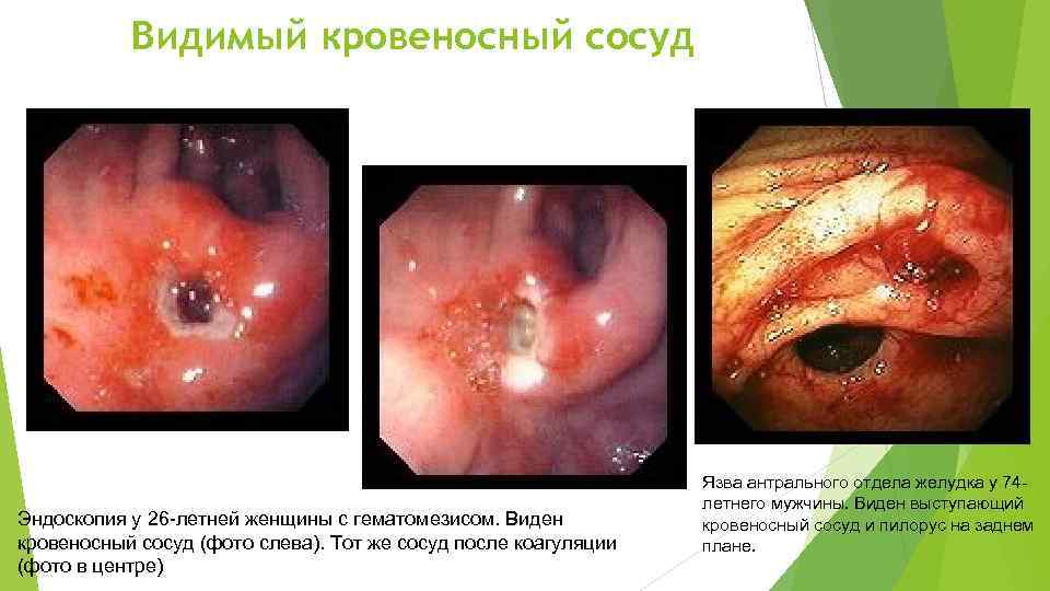 Видимый кровеносный сосуд Эндоскопия у 26 -летней женщины с гематомезисом. Виден кровеносный сосуд (фото