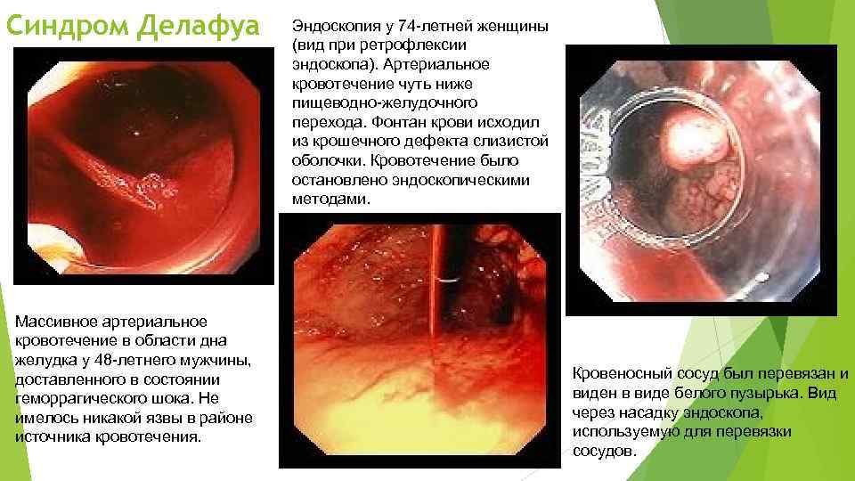 Синдром Делафуа Массивное артериальное кровотечение в области дна желудка у 48 -летнего мужчины, доставленного
