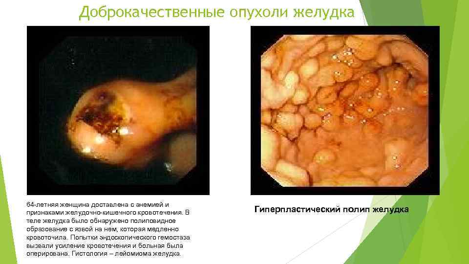 Доброкачественные опухоли желудка 64 -летняя женщина доставлена с анемией и признаками желудочно-кишечного кровотечения. В