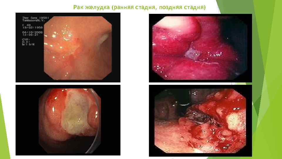 Рак желудка (ранняя стадия, поздняя стадия) 