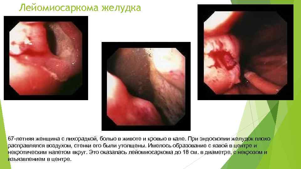 Лейомиосаркома желудка 67 -летняя женщина с лихорадкой, болью в животе и кровью в кале.