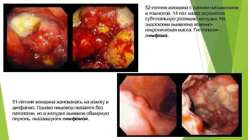 52 -летняя женщина с ранним насыщением и тошнотой. 14 лет назад перенесла субтотальную резекцию