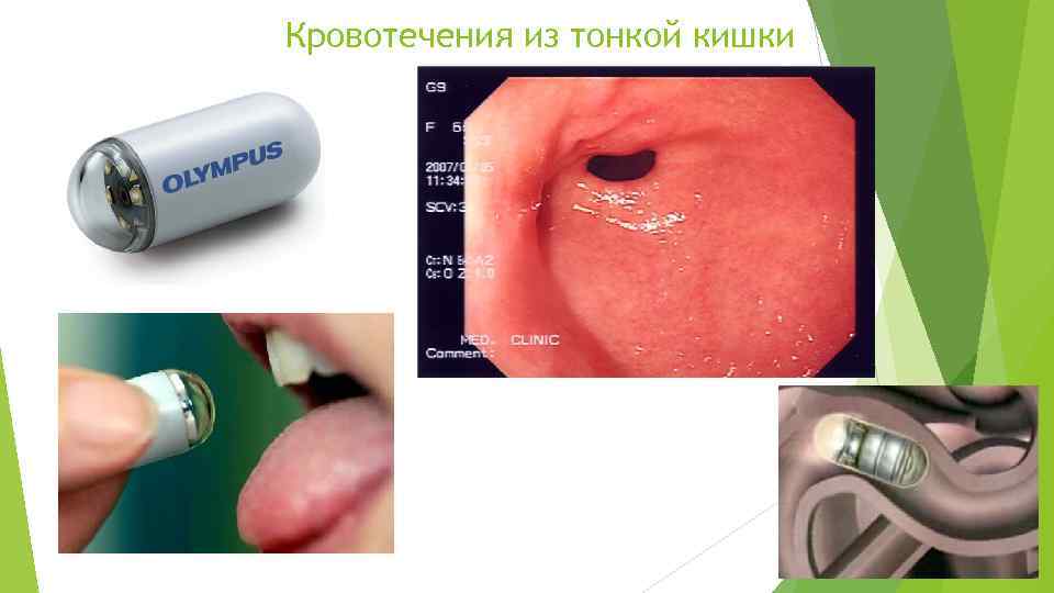 Кровотечения из тонкой кишки 