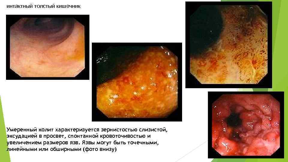 интактный толстый кишечник Умеренный колит характеризуется зернистостью слизистой, эксудацией в просвет, спонтанной кровоточивостью и
