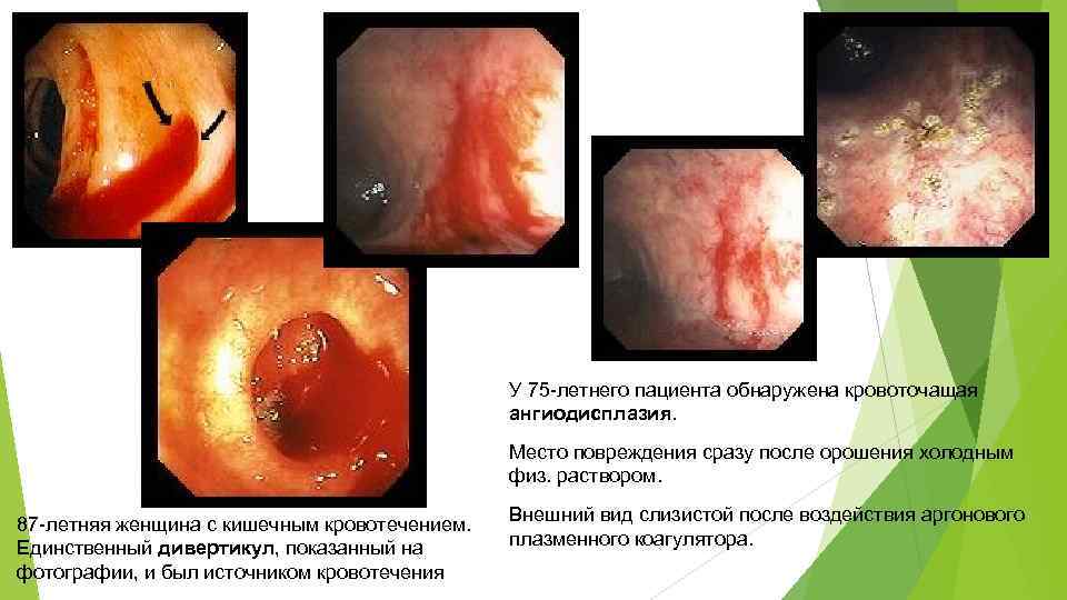 У 75 -летнего пациента обнаружена кровоточащая ангиодисплазия. Место повреждения сразу после орошения холодным физ.