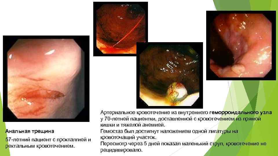 Анальная трещина 57 -летний пациент с прокталгией и ректальным кровотечением. Артериальное кровотечение из внутреннего