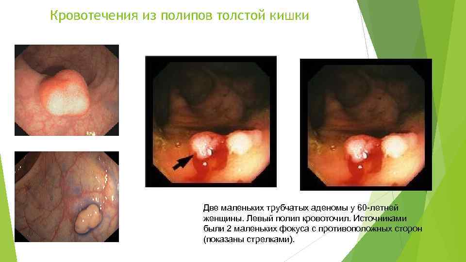 Кровотечения из полипов толстой кишки Две маленьких трубчатых аденомы у 60 -летней женщины. Левый
