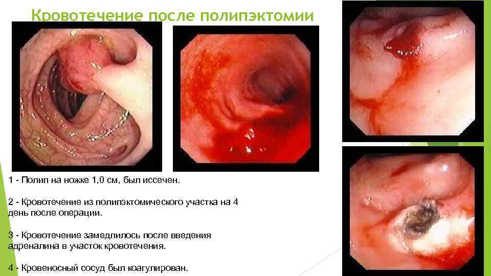 Кровотечение после полипэктомии 1 - Полип на ножке 1, 0 см, был иссечен. 2