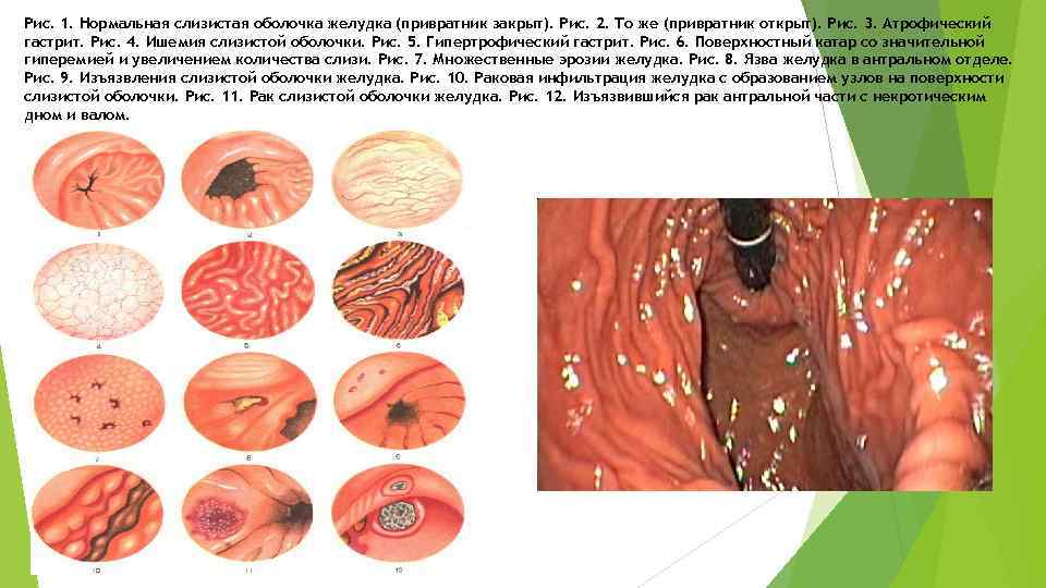 Рис. 1. Нормальная слизистая оболочка желудка (привратник закрыт). Рис. 2. То же (привратник открыт).
