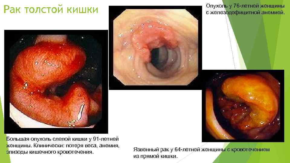 Рак толстой кишки Большая опухоль слепой кишки у 91 -летней женщины. Клинически: потеря веса,