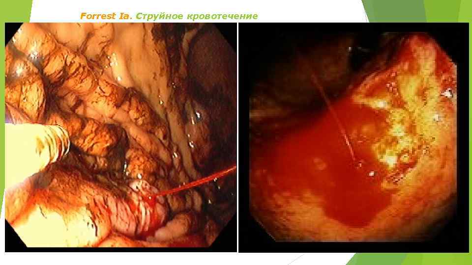 Forrest Ia. Струйное кровотечение 
