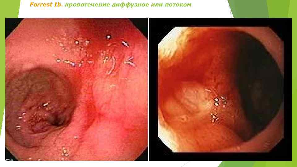 Forrest Ib. кровотечение диффузное или потоком 