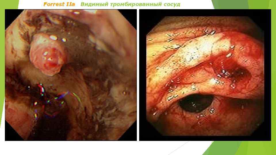 Forrest IIa Видимый тромбированный сосуд 