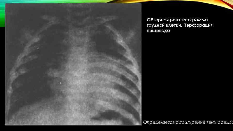 Обзорная рентгенограмма грудной клетки. Перфорация пищевода Определяется расширение тени средос 