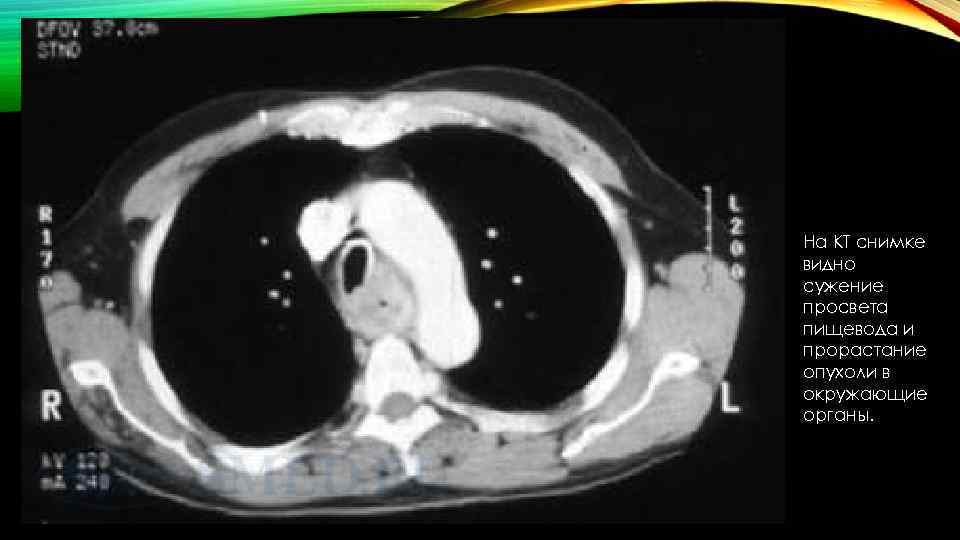 На КТ снимке видно сужение просвета пищевода и прорастание опухоли в окружающие органы. 