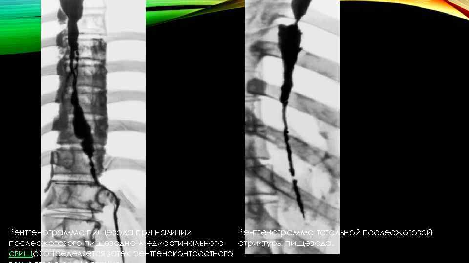 Рентгенограмма пищевода при наличии Рентгенограмма тотальной послеожогового пищеводно-медиастинального стриктуры пищевода. свища: определяется затек рентгеноконтрастного