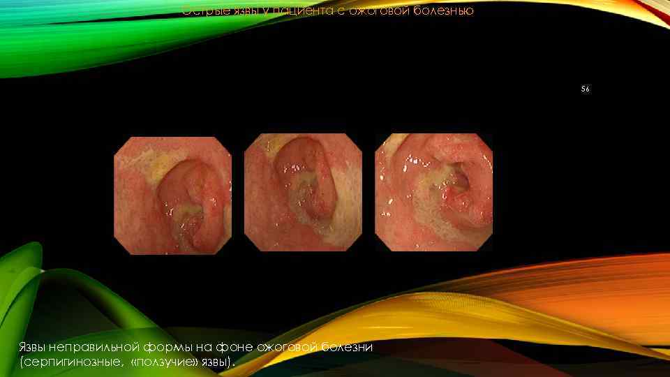 Острые язвы у пациента с ожоговой болезнью 56 Язвы неправильной формы на фоне ожоговой