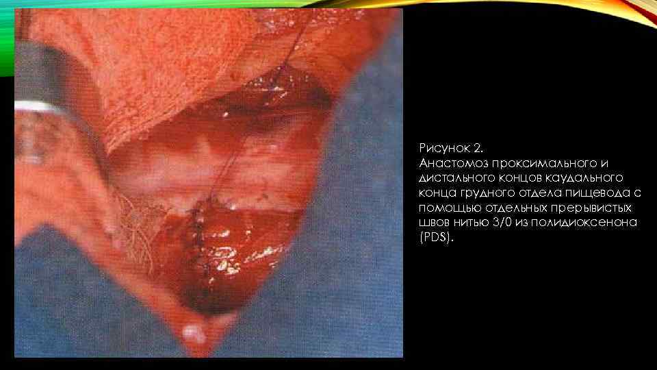 Рисунок 2. Анастомоз проксимального и дистального концов каудального конца грудного отдела пищевода с помощью