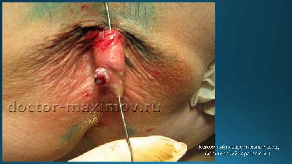 Подкожный параректальный свищ (хронический парапроктит) 