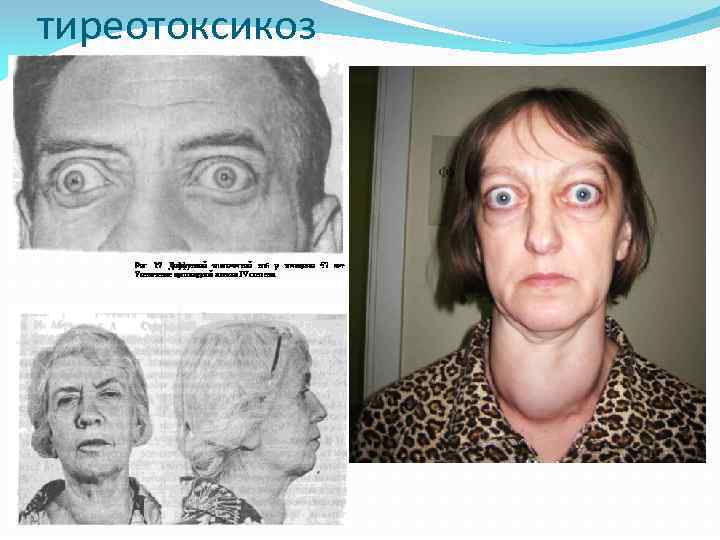тиреотоксикоз 