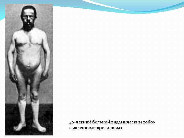 40 -летний больной эндемическим зобом с явлениями кретинизма 